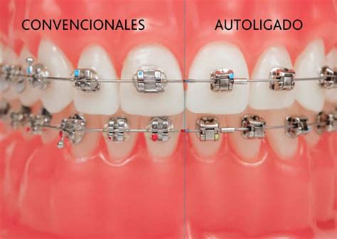 brackets metalicos vs autoligados|brackets autoligables diferencias.